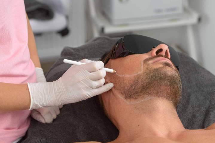 Épilation définitive au laser pour homme Outaouais