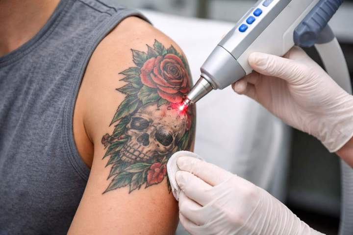 Remove a tattoo or permanent makeup safely and permanently.