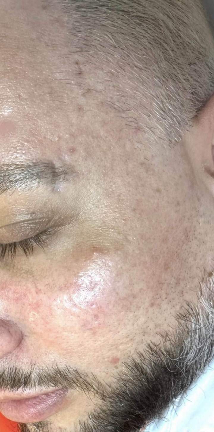 Après 3 sessions d'Hollywood Peel Homme