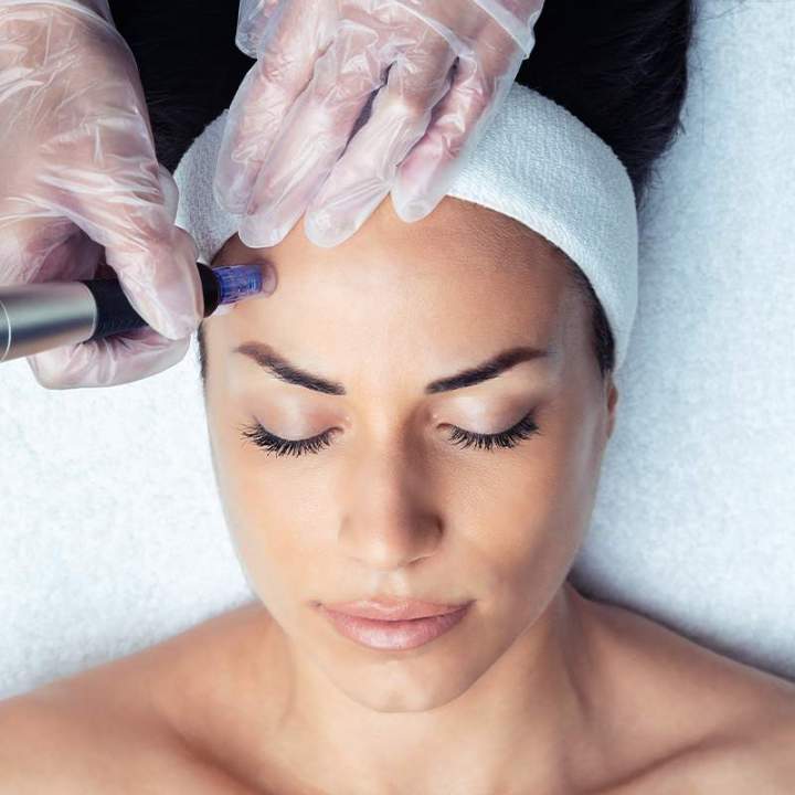 Microneedling in Gatineau