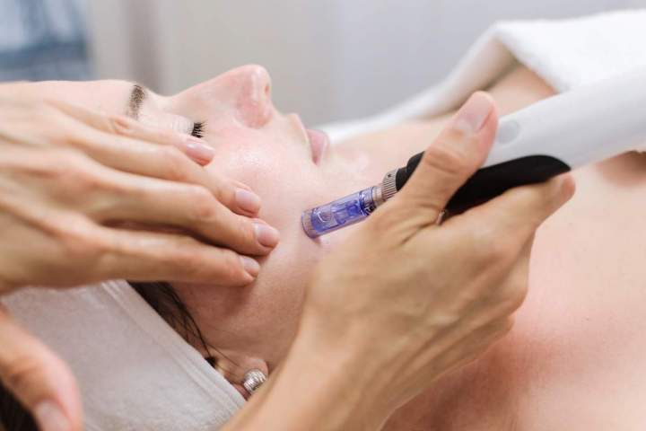 Microneedling Treatment in Gatineau