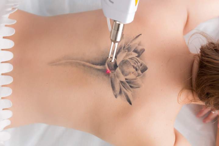 Détatouage laser Outaouais