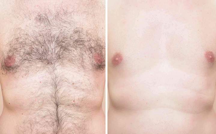 Épilation permanente au laser Outaouais