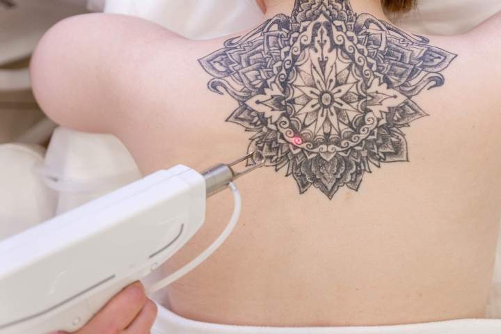 Laser tattoo removal Gatineau
