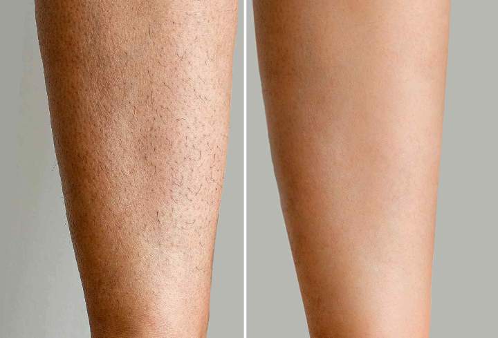 Épilation définitive sans douleur au laser Outaouais